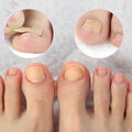 Kit of 100 Ingrown Toenail Correction Patches