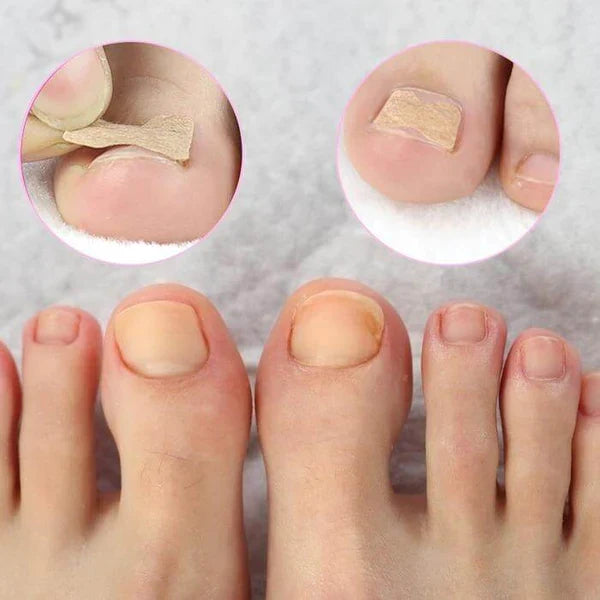 Kit of 100 Ingrown Toenail Correction Patches