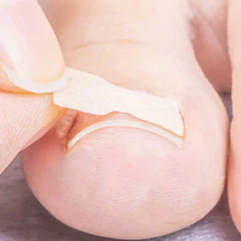 Kit of 100 Ingrown Toenail Correction Patches